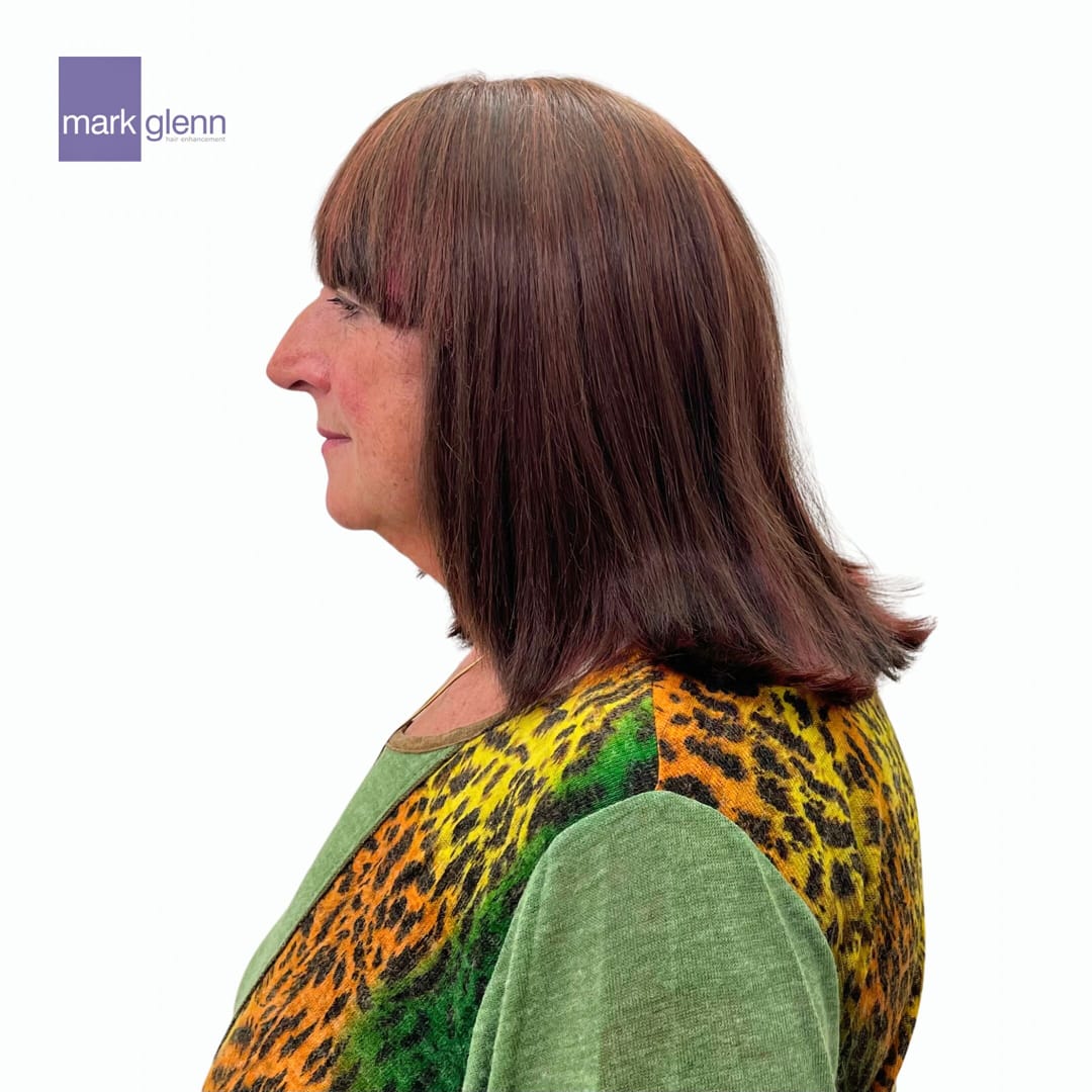 After Picture - Cancer Chemotherapy Permanent Hair Loss Transformation