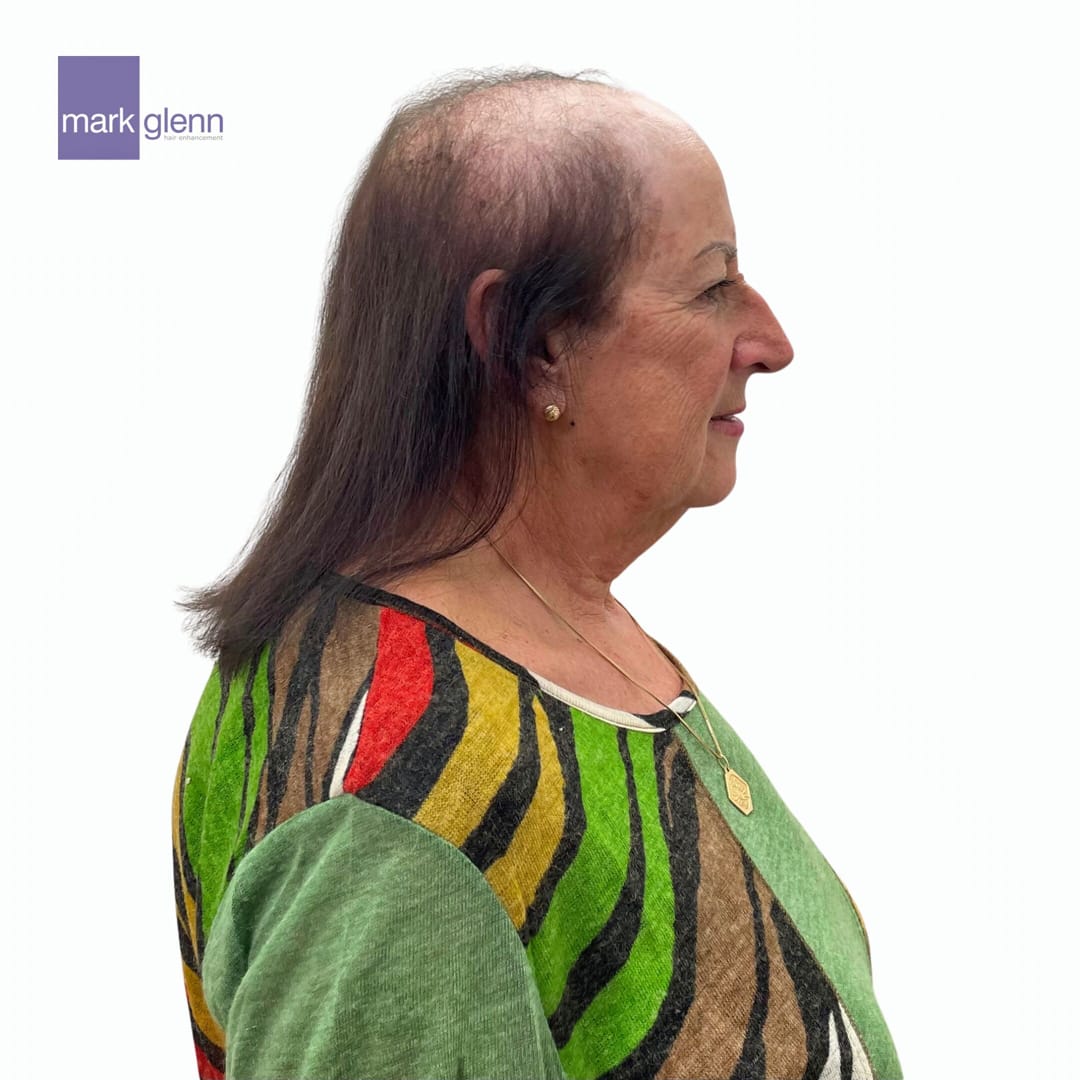 Before Picture - Cancer Chemotherapy Permanent Hair Loss Transformation