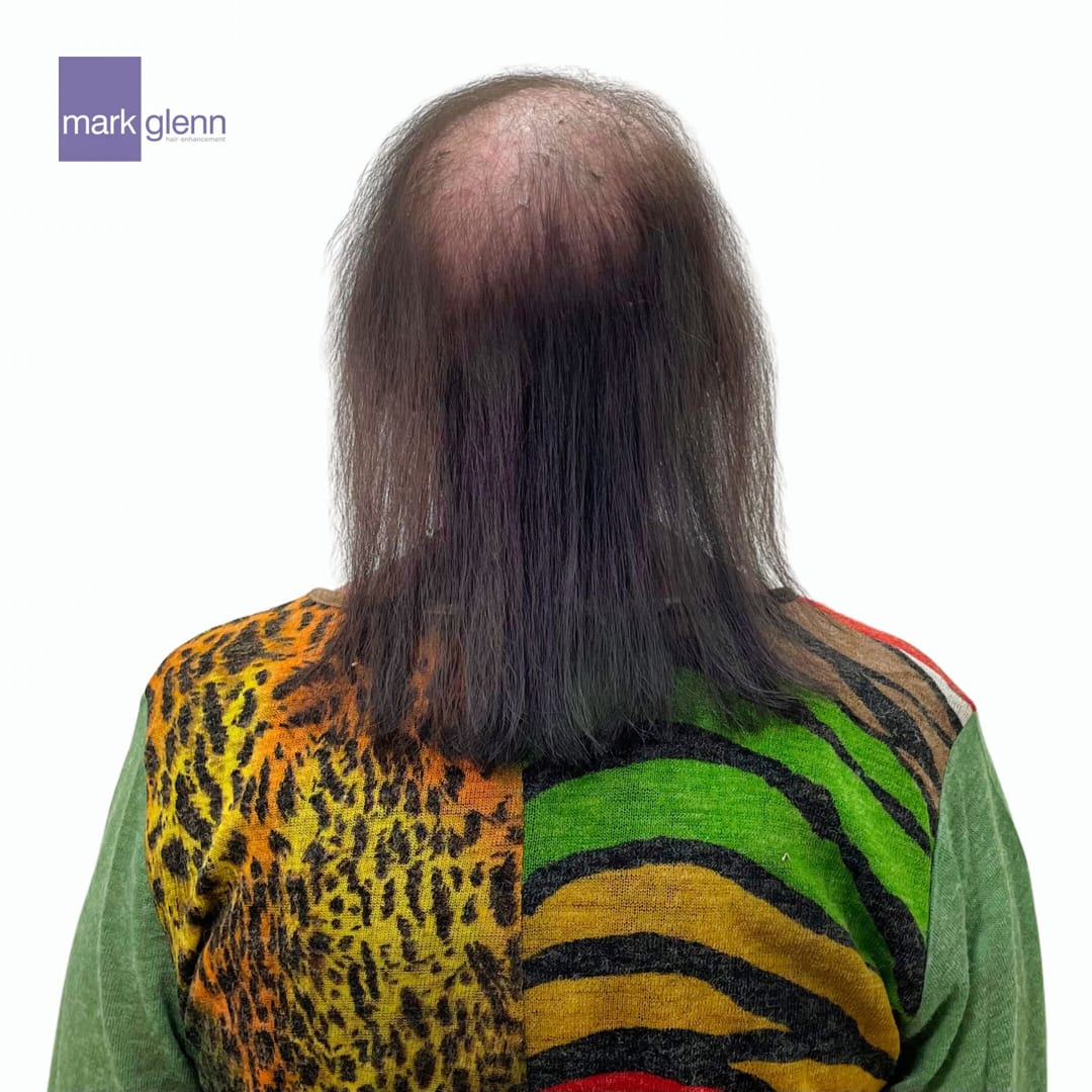 Before Picture - Cancer Chemotherapy Permanent Hair Loss Transformation