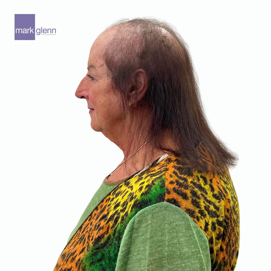 Before Picture - Cancer Chemotherapy Permanent Hair Loss Transformation