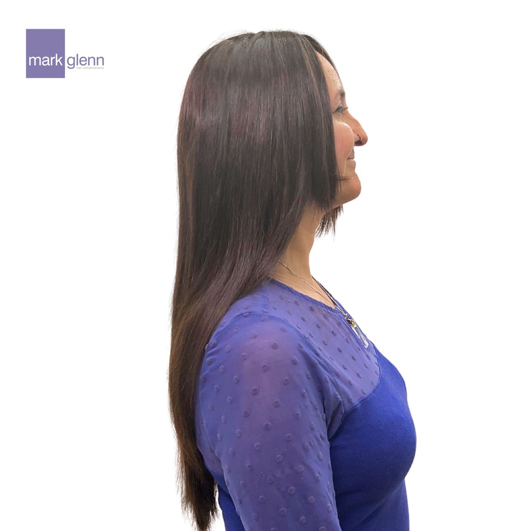 After Picture - Semi-Permanent Superior Wig-Alternative for Alopecia Hair Loss