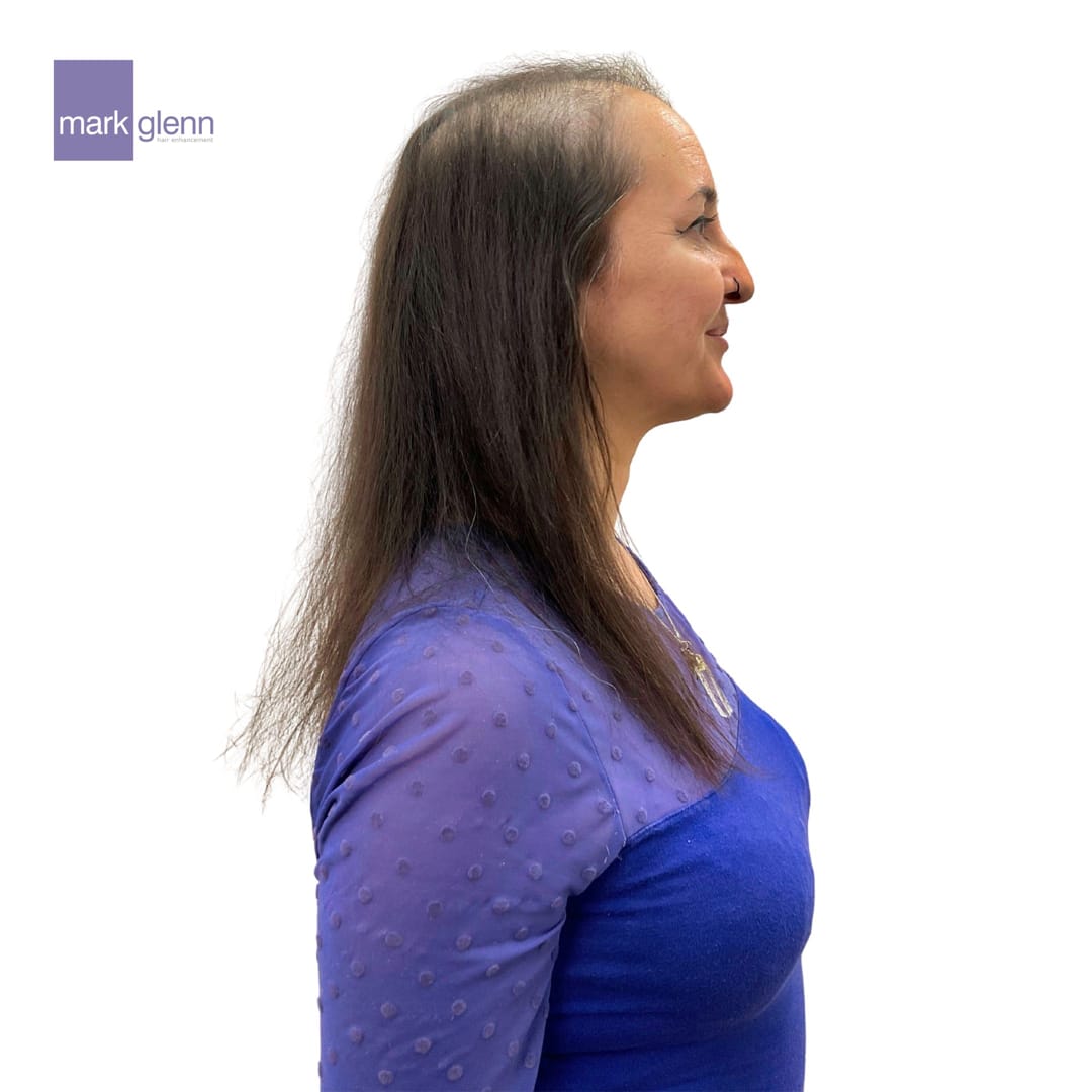 Before Picture - Semi-Permanent Superior Wig-Alternative for Alopecia Hair Loss