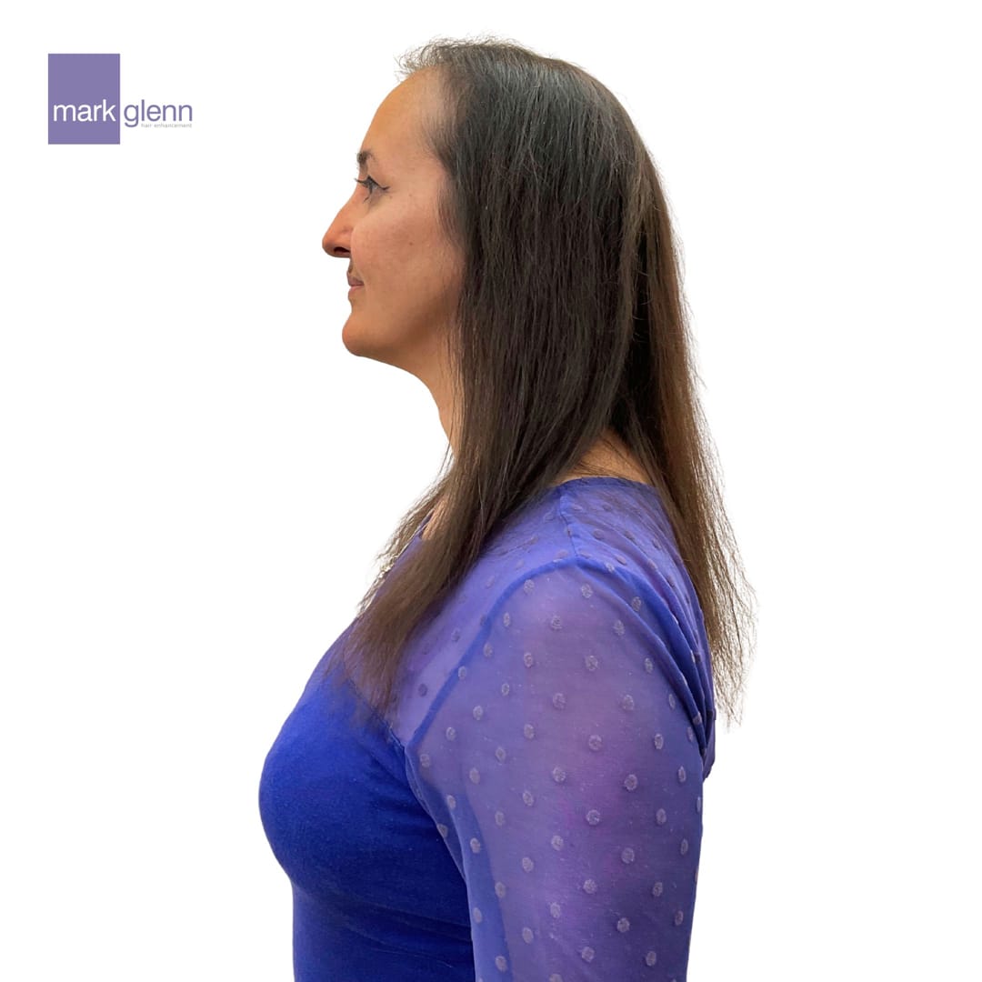 Before Picture - Semi-Permanent Superior Wig-Alternative for Alopecia Hair Loss