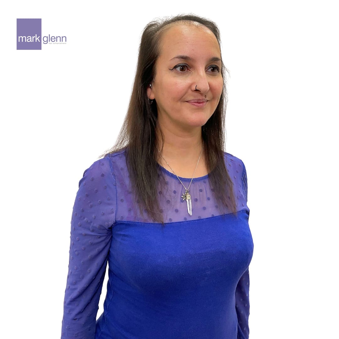 Before Picture - Semi-Permanent Superior Wig-Alternative for Alopecia Hair Loss