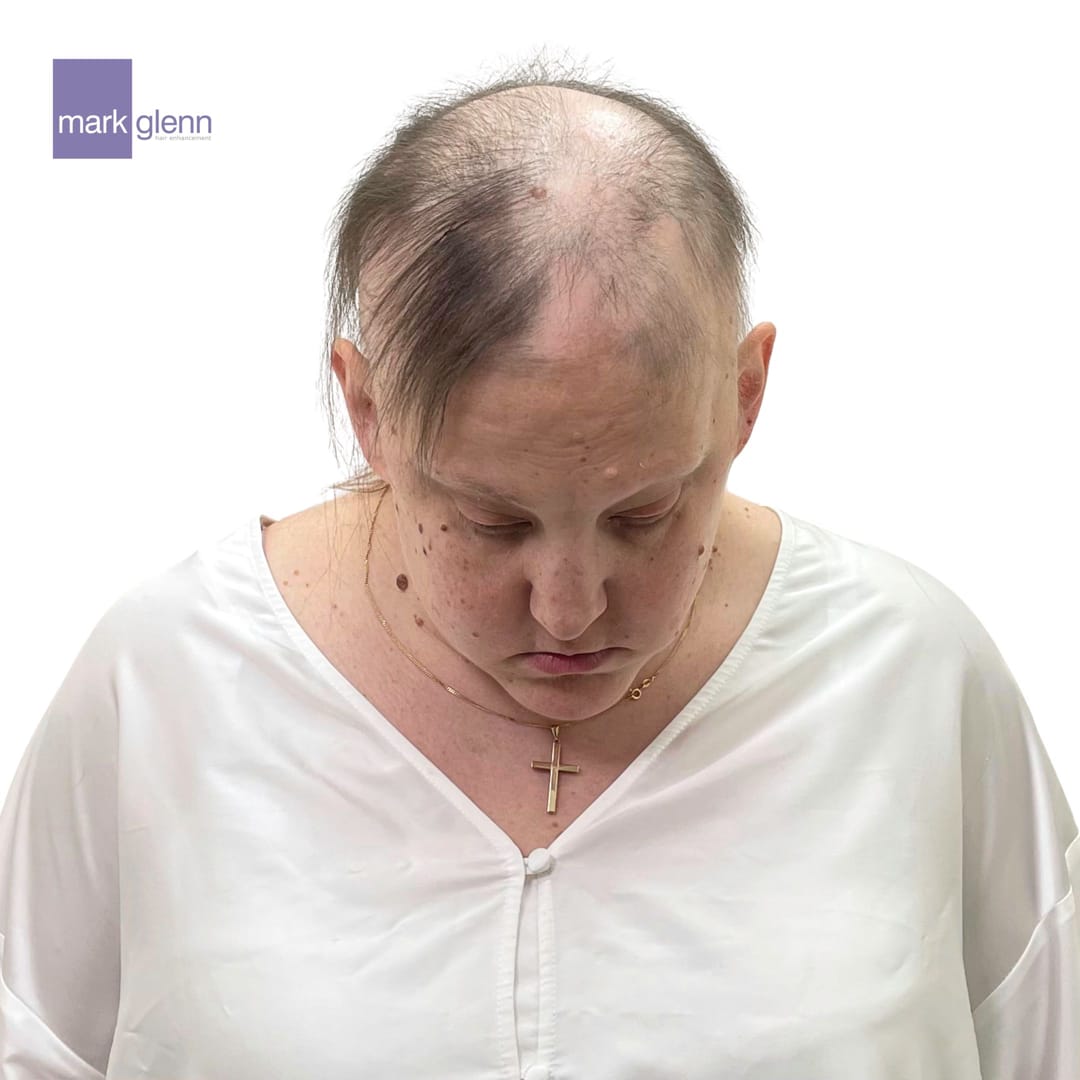Before Picture - Alopecia Areata Miracle Makeover