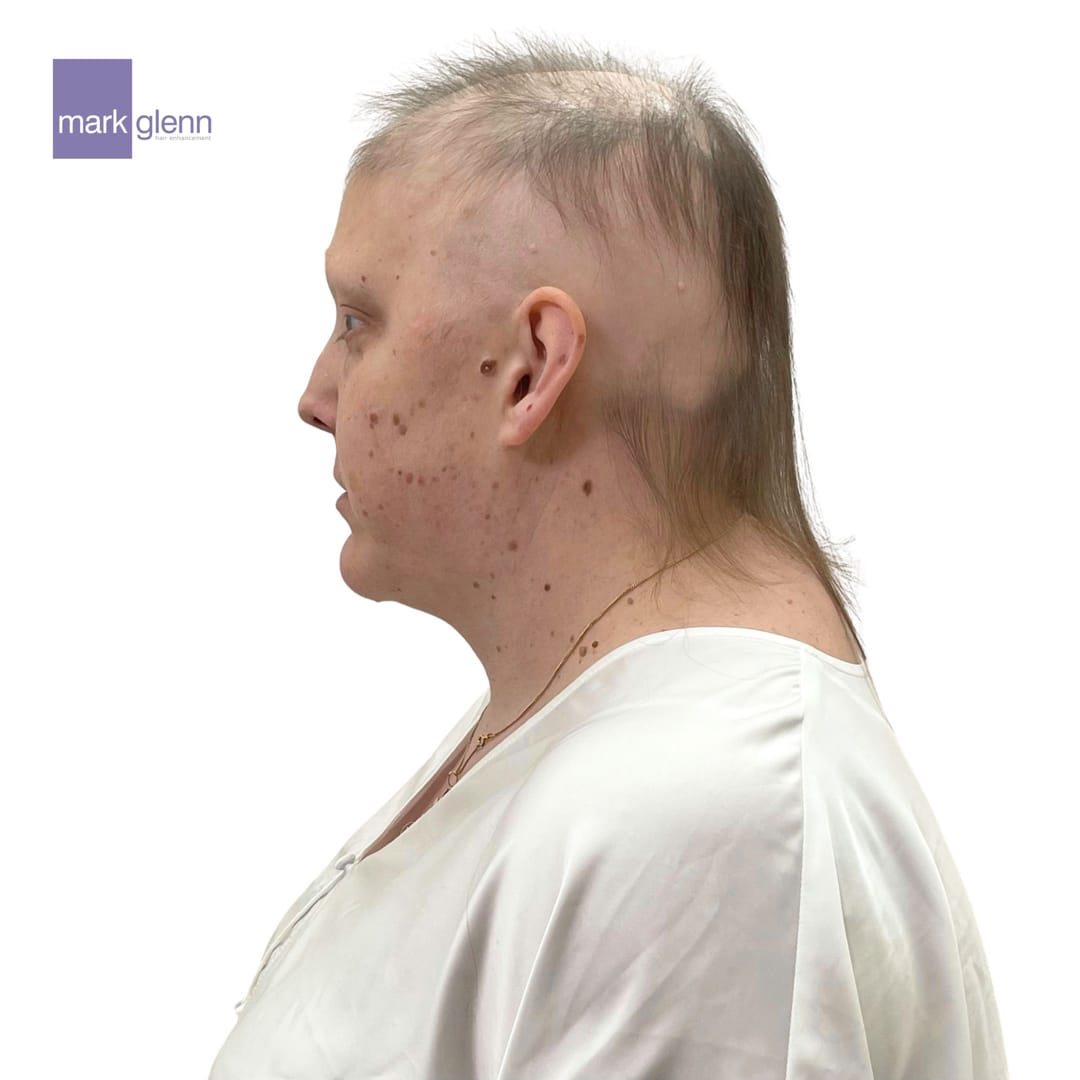 Before Picture - Alopecia Areata Miracle Makeover