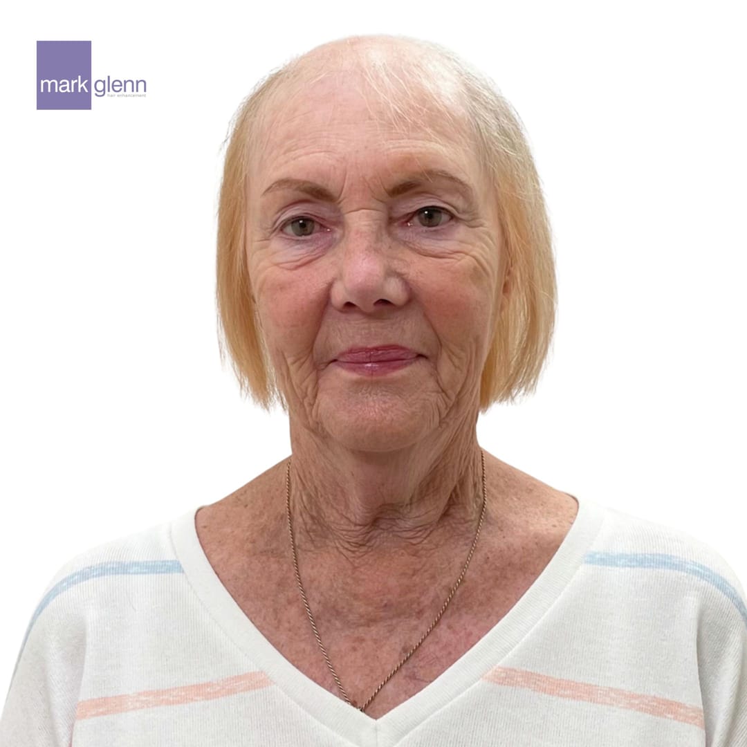 Before Picture - Female Pattern Hair Loss / Androgenetic Alopecia Magical Makeover