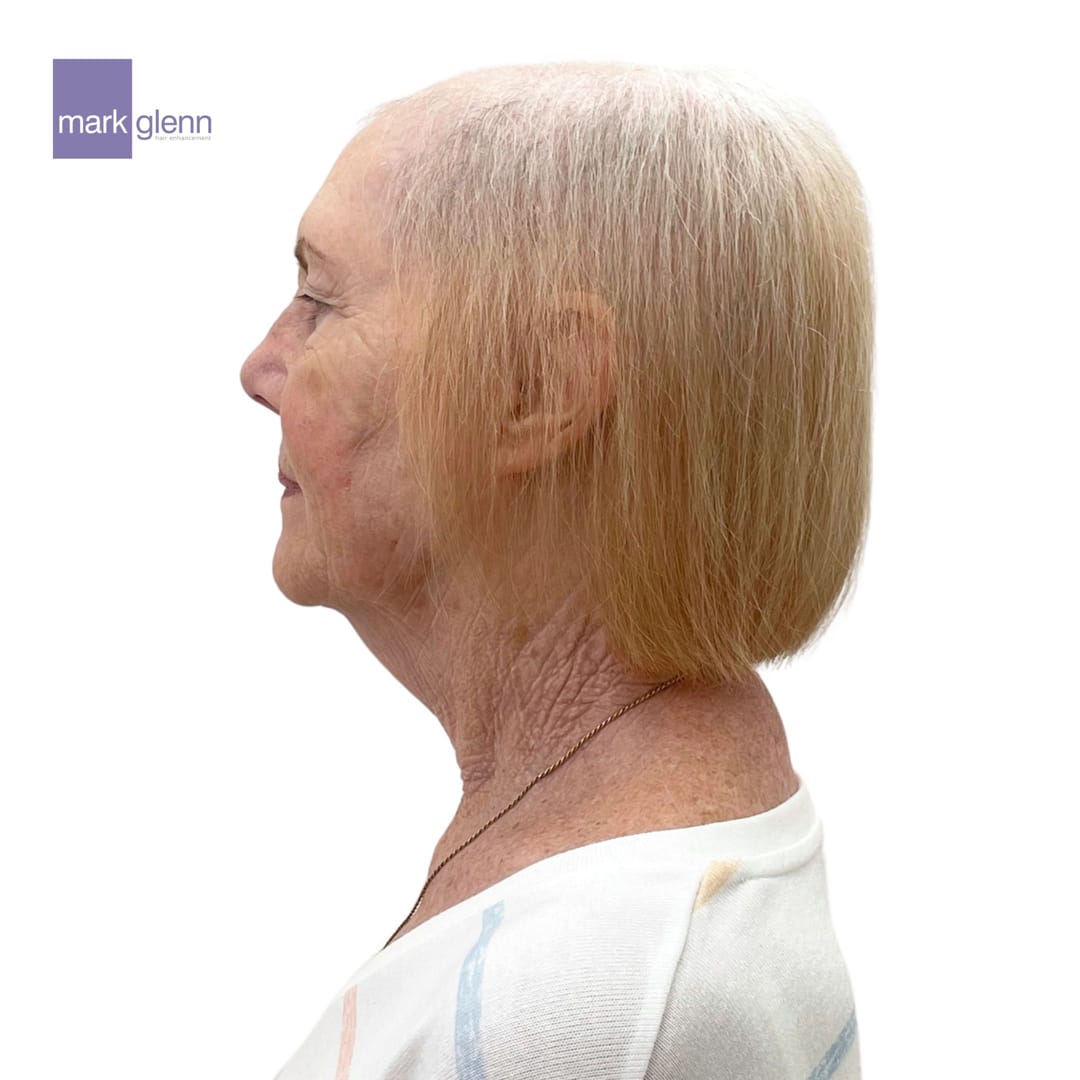 Before Picture - Female Pattern Hair Loss / Androgenetic Alopecia Magical Makeover