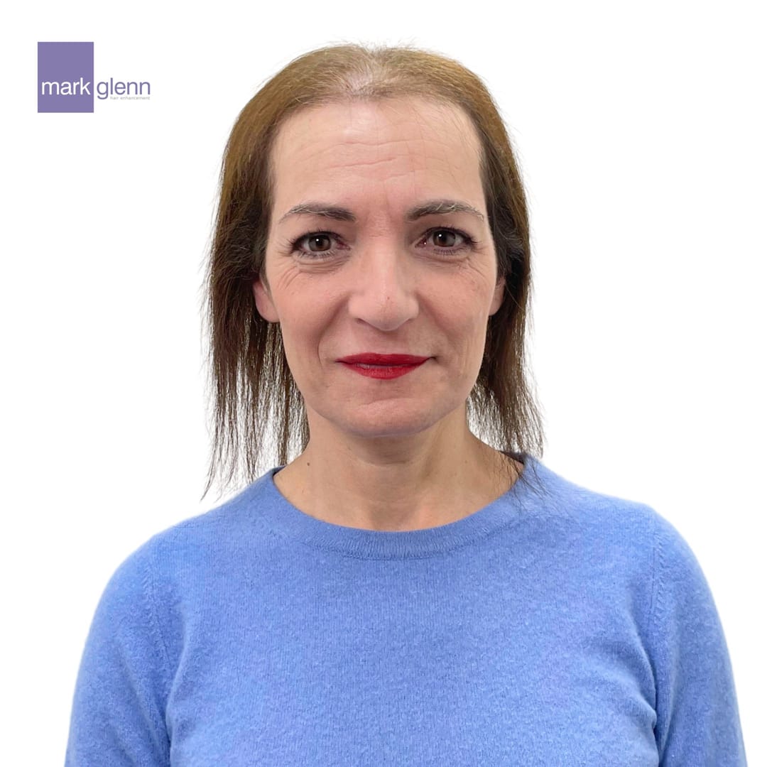 Before Picture - Superior Wig Alternative for Female Hair Loss