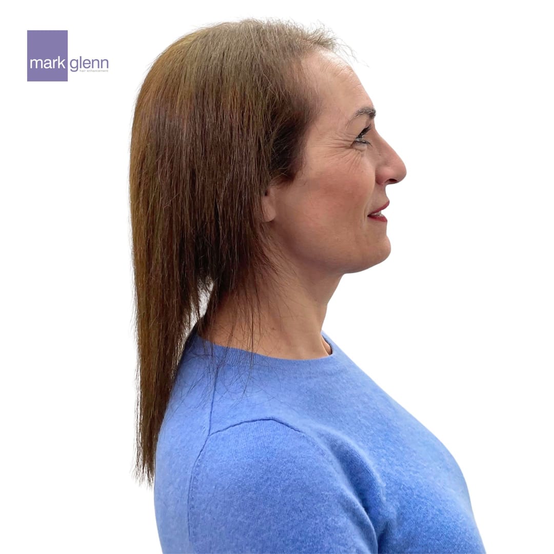 Before Picture - Superior Wig Alternative for Female Hair Loss