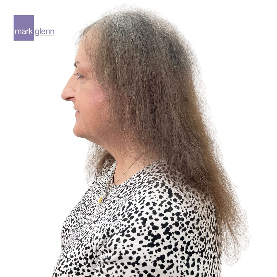 Before Picture - Women's' Hair Loss Semi-Permanent Wig Alternative
