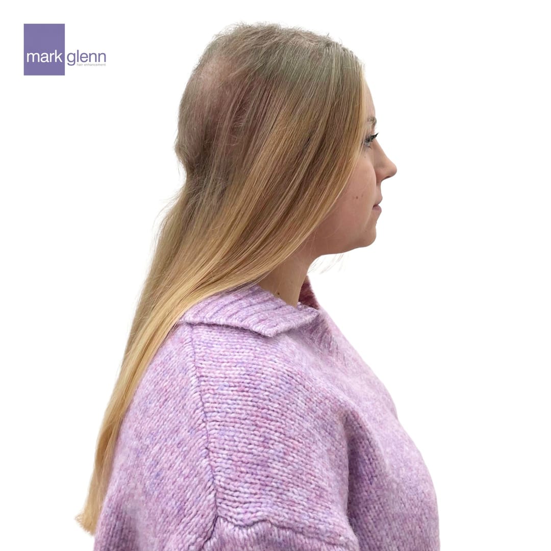 Before Picture - Effectively Tackling Trichotillomania with The Kinsey System