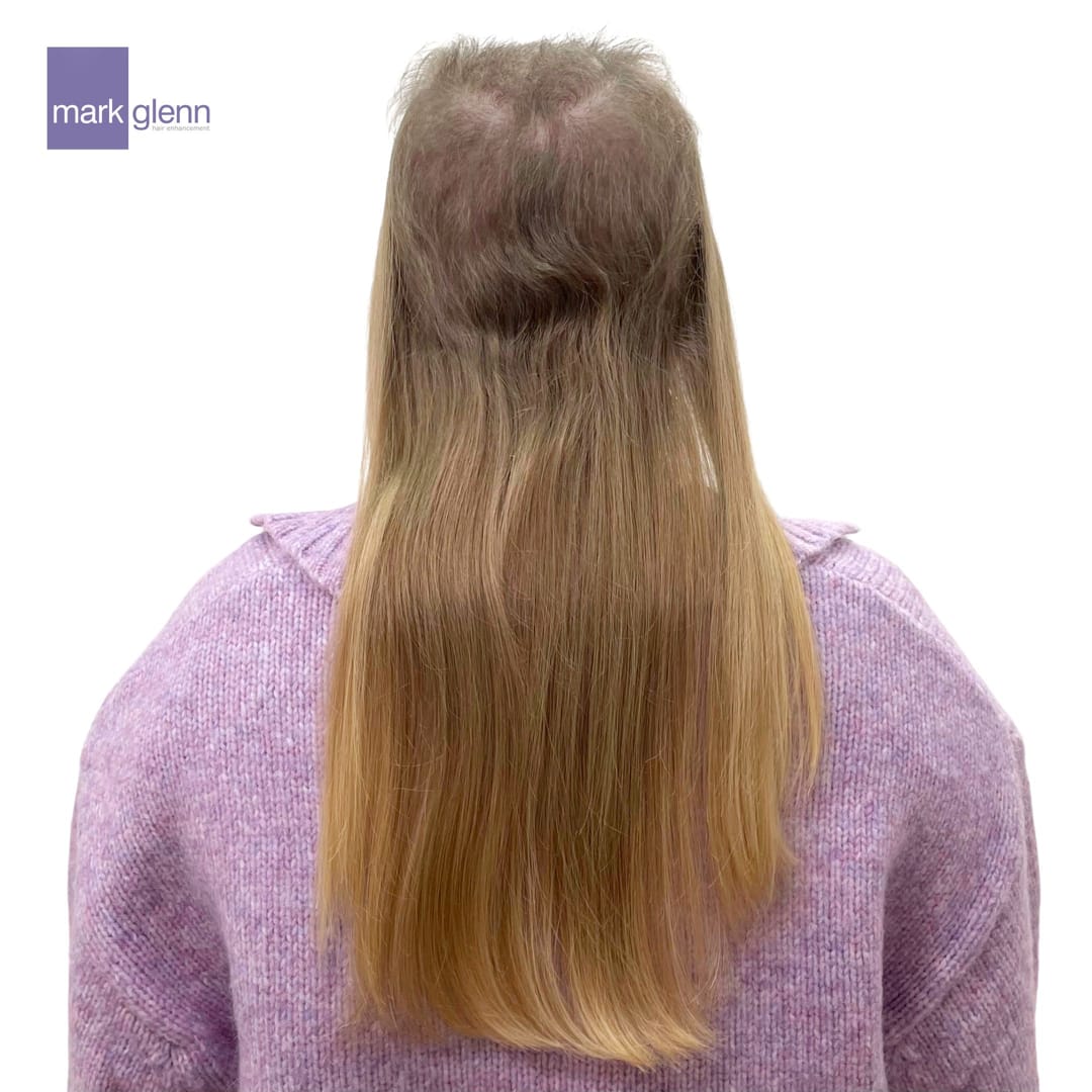 Before Picture - Effectively Tackling Trichotillomania with The Kinsey System