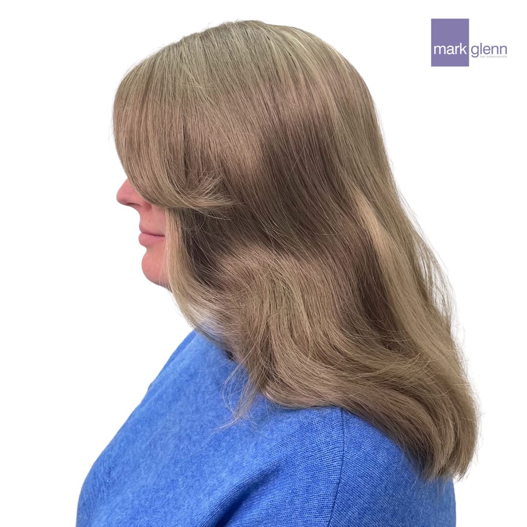 After Picture - Semi-Permanent Wig Alternative for Female Pattern Hair Loss