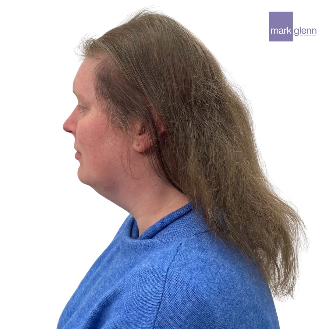 Before Picture - Semi-Permanent Wig Alternative for Female Pattern Hair Loss