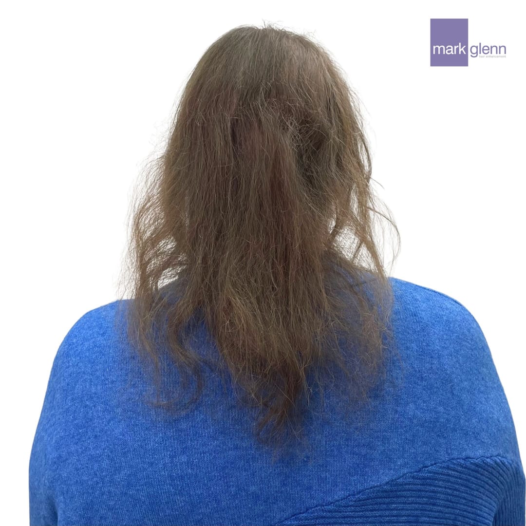 Before Picture - Semi-Permanent Wig Alternative for Female Pattern Hair Loss