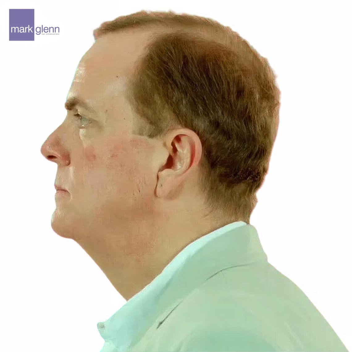 Before Picture - 'The Making of Me' - C4 Gender Change Documentary Features The Kinsey System Hair Integration