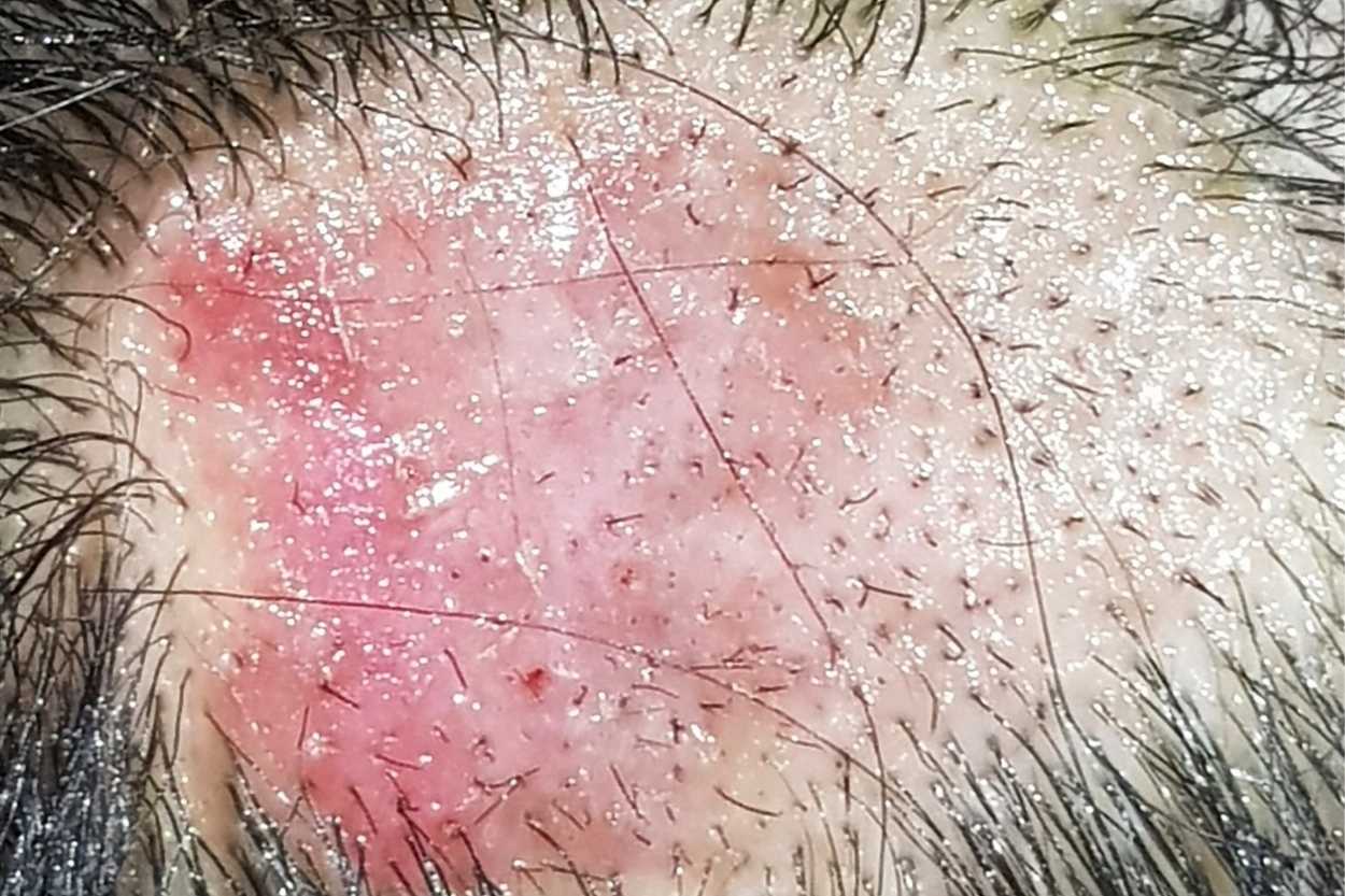 Scarring Alopecia or Cicatricial Alopecia