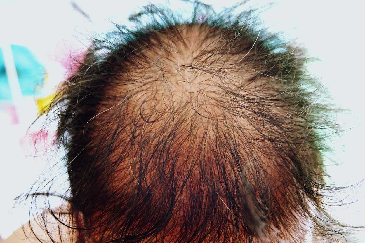 Androgenetic Alopecia or Female Pattern Hair Loss