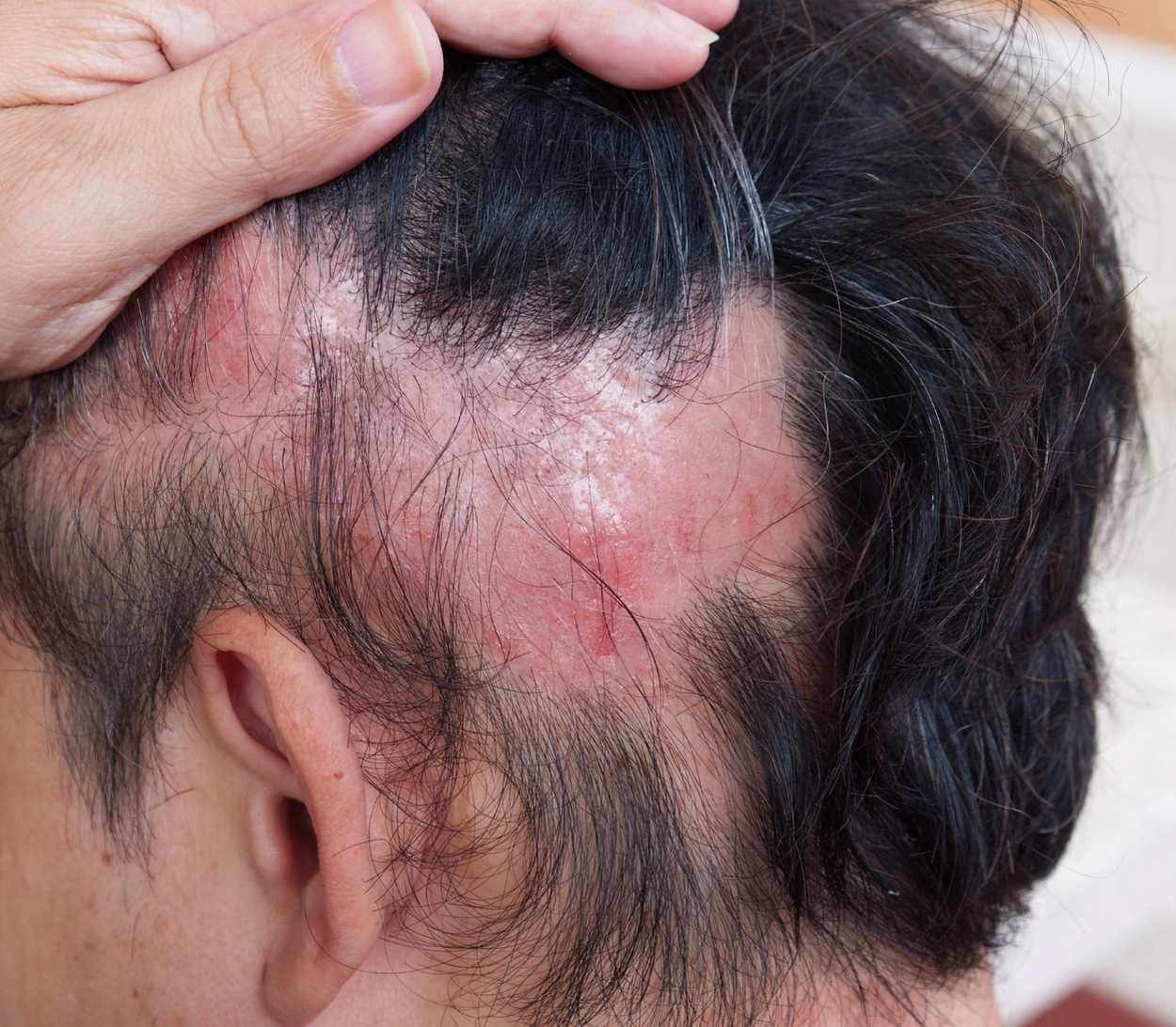 Alopecia Areata