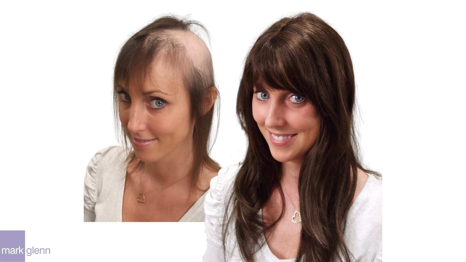 Female Hair Loss Replacement | Kinsey System for Women | Mark Glenn Hair  Enhancement, London, UK