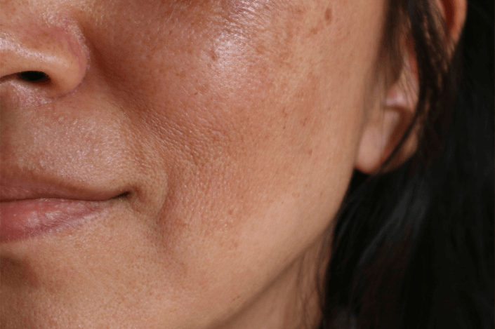 Curing your pigmentation problems with Dermamelan cream