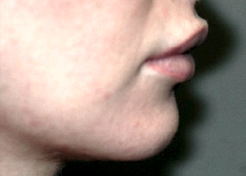 A photo of a person receiving Chin treatment.