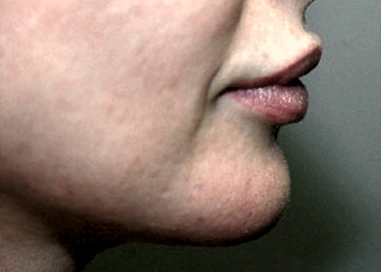 A photo of a person receiving Chin treatment.