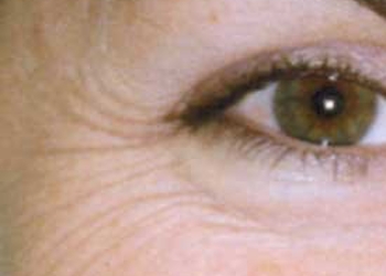 A photo of a person receiving Eyes treatment.