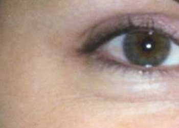 A photo of a person receiving Eyes treatment.