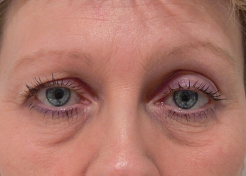 A photo of a person receiving Eyes treatment.