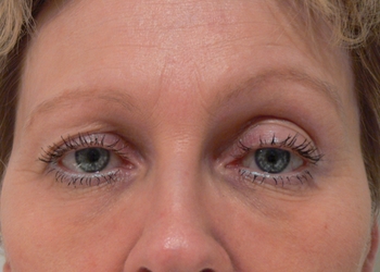 A photo of a person receiving Eyes treatment.