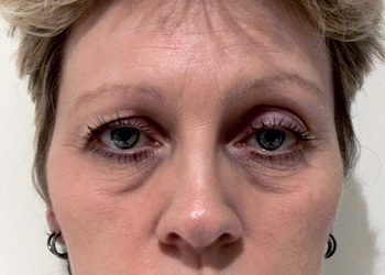 A photo of a person receiving Eyes treatment.