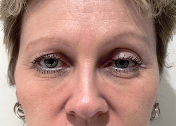 A photo of a person receiving Eyes treatment.