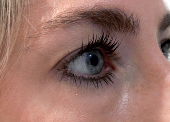 A photo of a person receiving Eyes treatment.