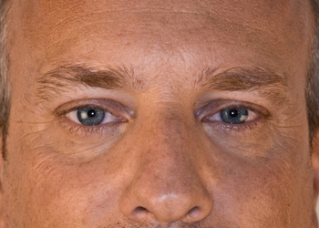 A photo of a person receiving Eyes treatment.