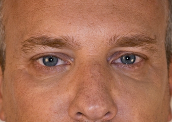 A photo of a person receiving Eyes treatment.