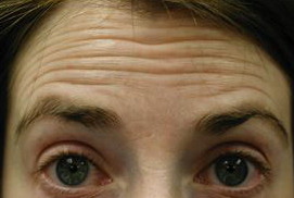 A photo of a person receiving Forehead treatment.