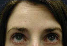 A photo of a person receiving Forehead treatment.