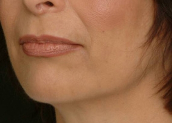 A photo of a person receiving Jowls treatment.