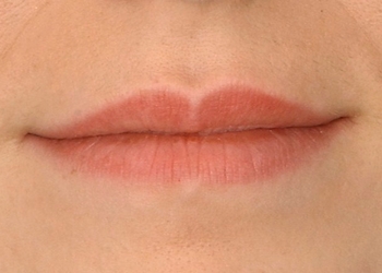 A photo of a person receiving Lips treatment.