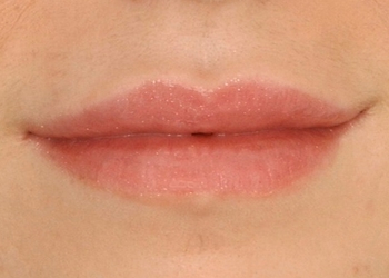 A photo of a person receiving Lips treatment.