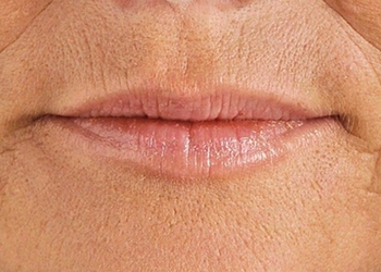 A photo of a person receiving Lips treatment.