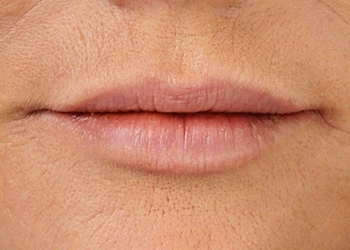 A photo of a person receiving Lips treatment.
