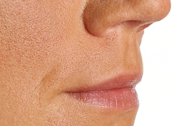 A photo of a person receiving Lips treatment.