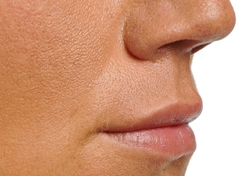 A photo of a person receiving Lips treatment.