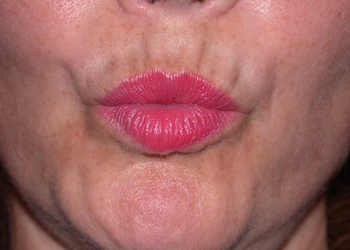 A photo of a person receiving Lips treatment.