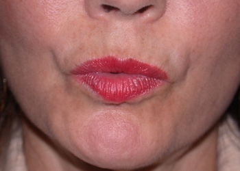 A photo of a person receiving Lips treatment.