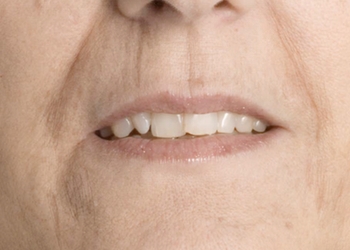 A photo of a person receiving Lips treatment.