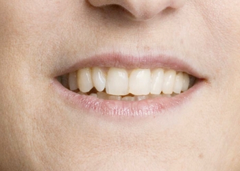 A photo of a person receiving Lips treatment.